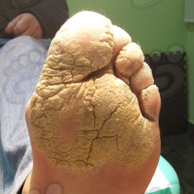 La psoriasis: enfermedad dérmica crónica