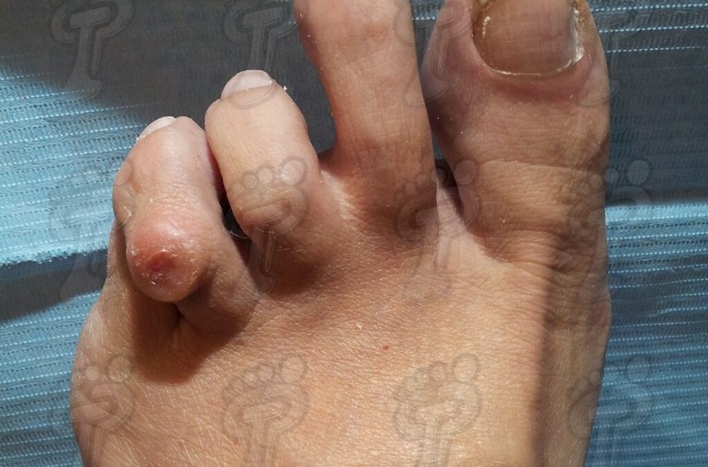 Generalidades sobre el pie reumático