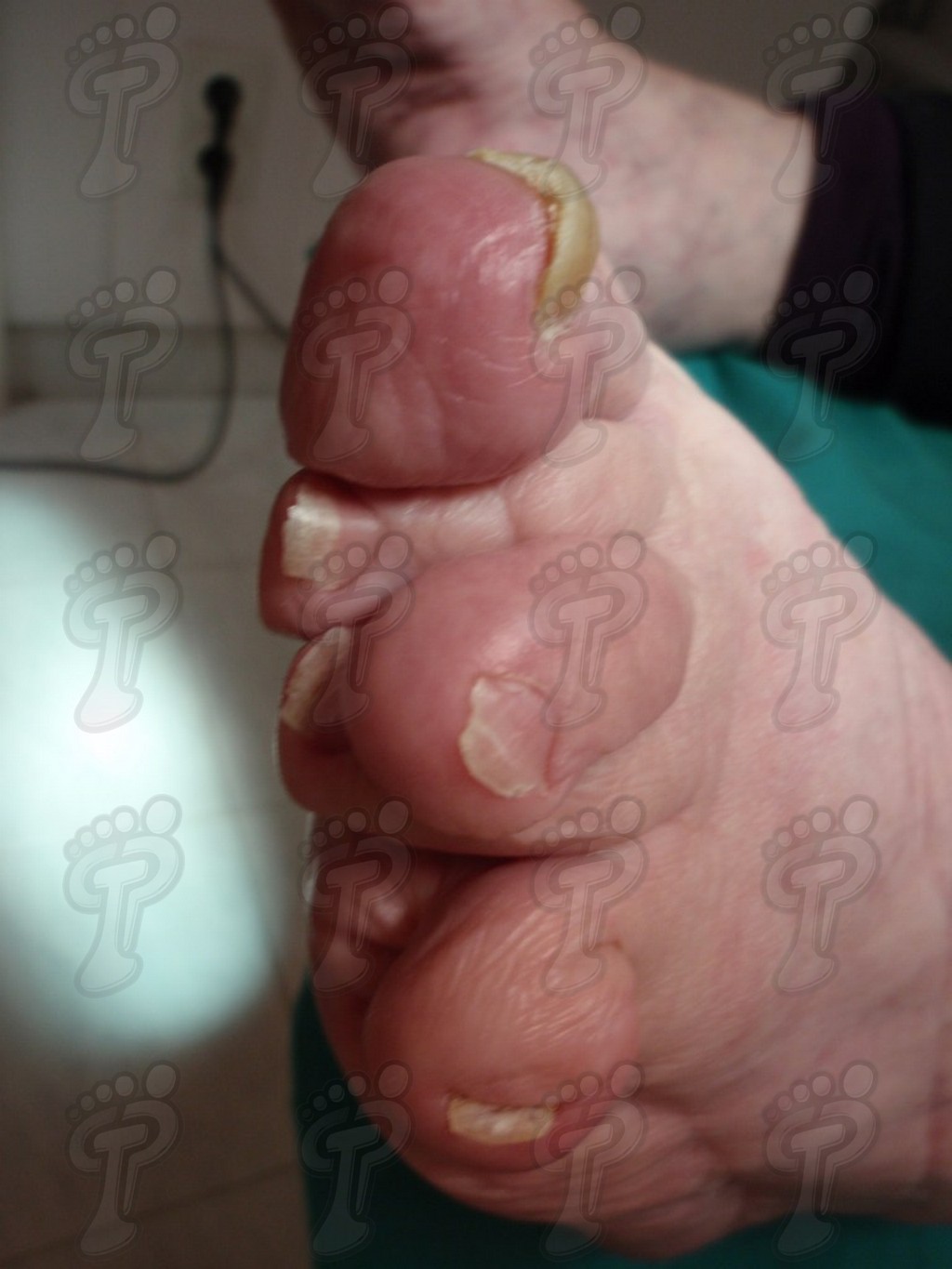 Overview of the rheumatoid foot