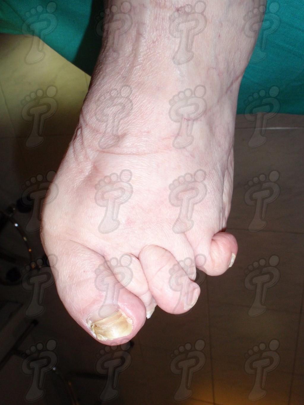 Overview of the rheumatoid foot
