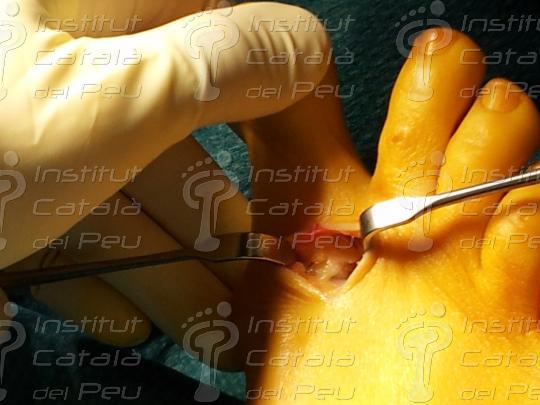 Técnica de scarf para el tratamiento del hallux valgus