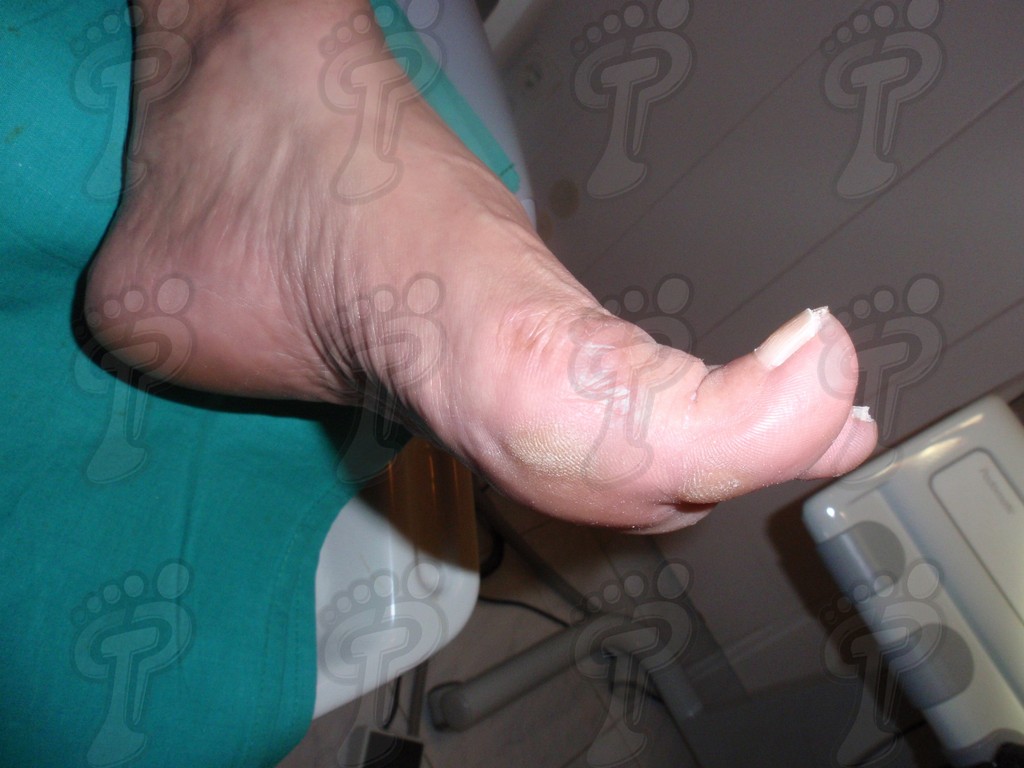 Hallux extensus: first toe deformity in the sagittal plane