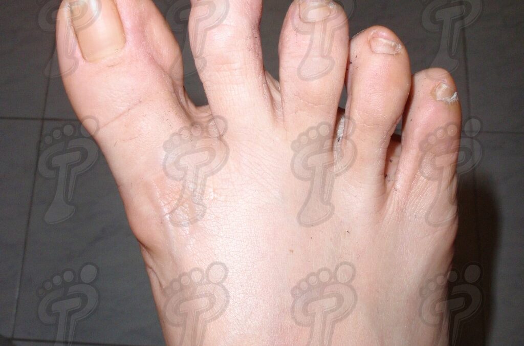 Hallux varus: la morfología contraria del hallux valgus