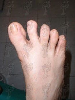 Hallux varus: la morfologia contrària de l’hallux valgus
