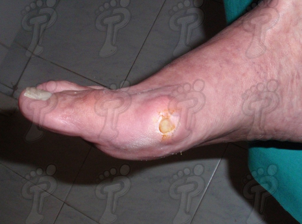 The diabetic foot: general considerations