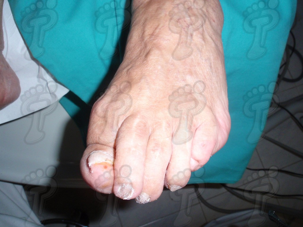 Hallux extensus: first toe deformity in the sagittal plane