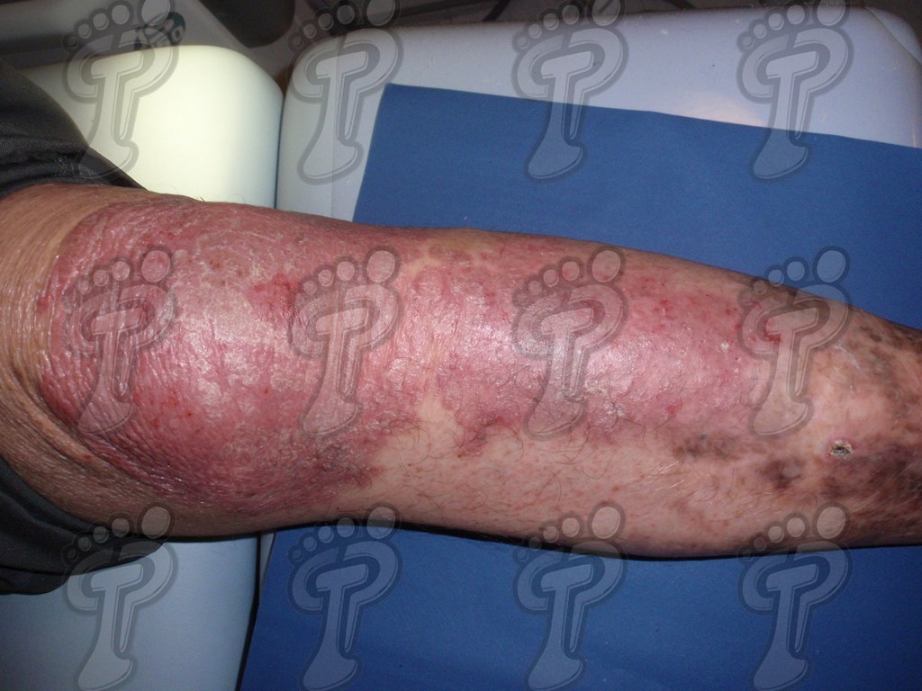 Псориаз: хроническое заболевание кожи