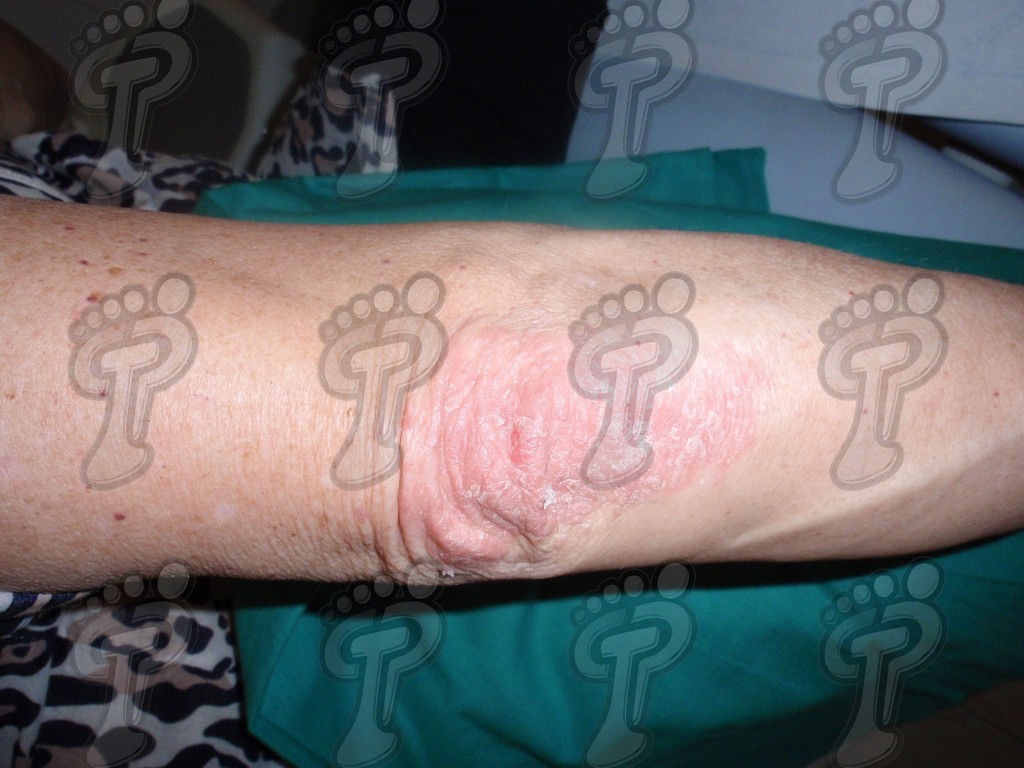 Псориаз: хроническое заболевание кожи