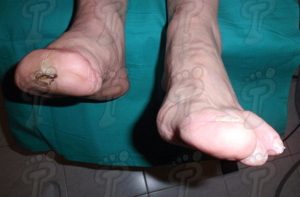 Elaboración de prótesis transmetatarsianas