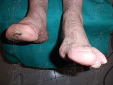 Elaboració de pròtesis transmetatarsianes