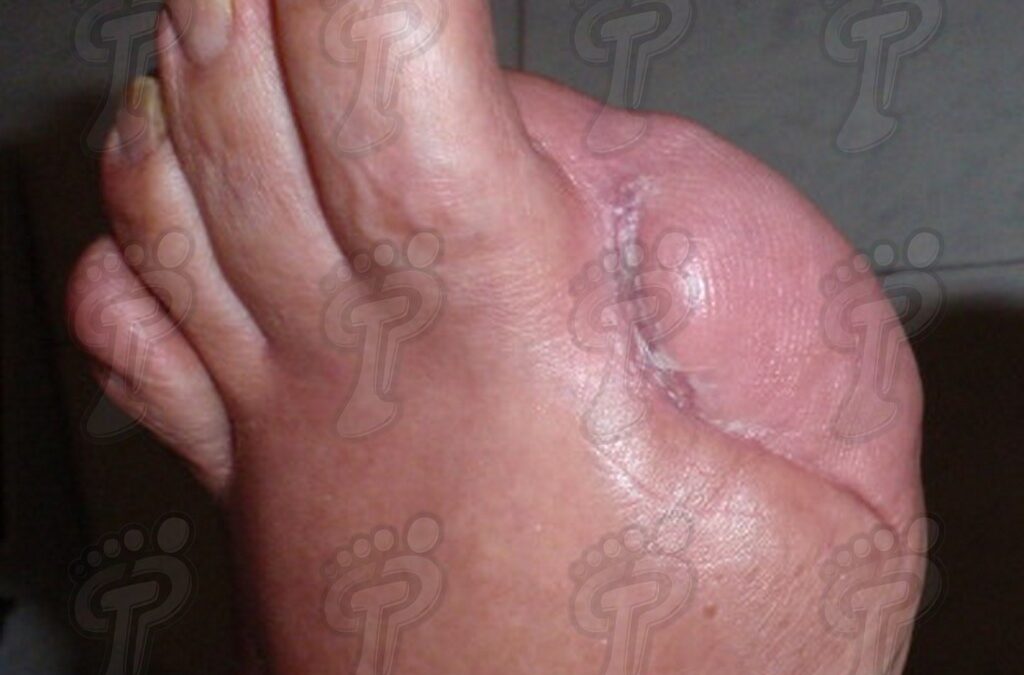 Amputaciones más frecuentes de la extremidad inferior