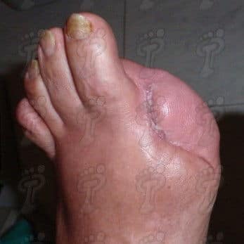 Amputacions més freqüents de l’extremitat inferior