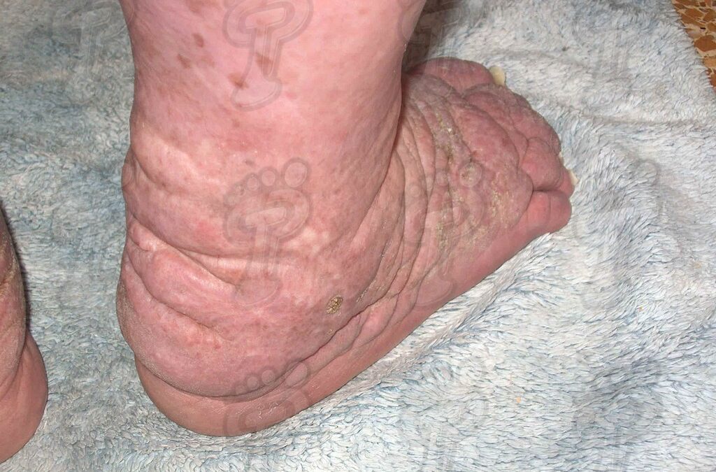 La elefantiasis o linfedema crónico