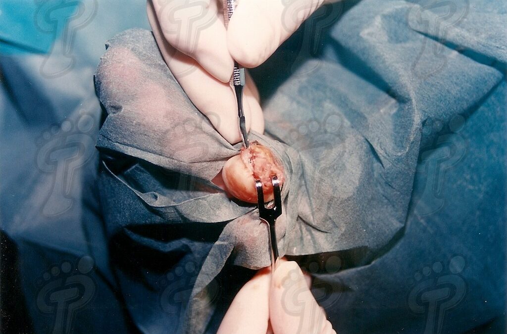 Tratamiento quirúrgico del osteoma osteoide