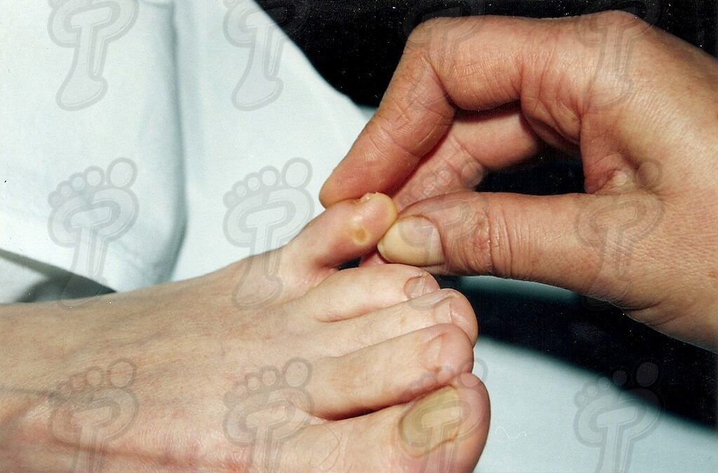 Tratamiento quirúrgico de una exóstosis interdigital