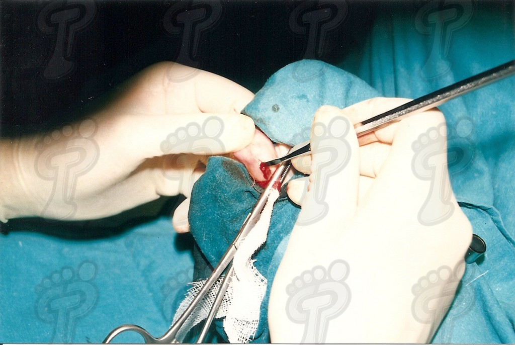 Tractament quirúrgic d’una exostosi interdigital