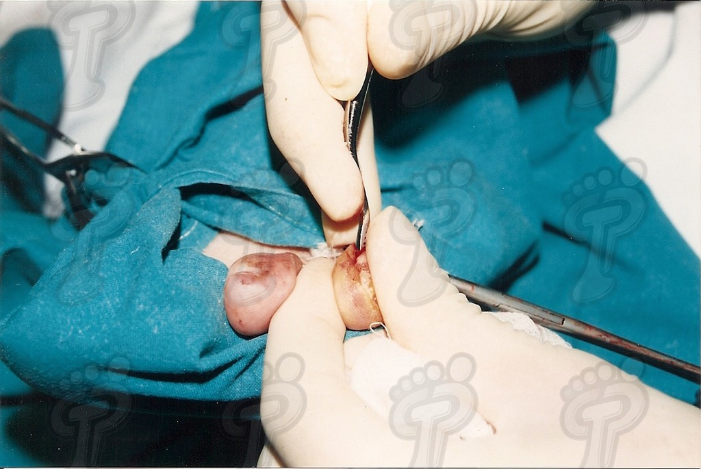 Tractament quirúrgic d’una exostosi interdigital