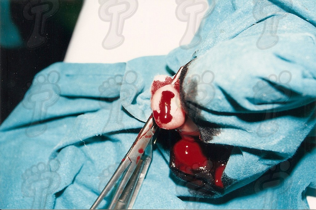 Tratamiento quirúrgico de una exóstosis interdigital