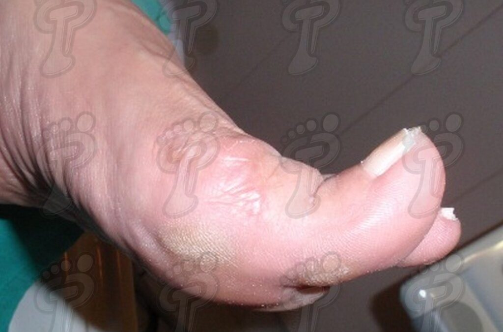 Hallux extensus: deformidad del primer dedo en el plano sagital