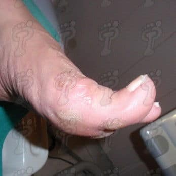 Hallux extensus: deformitat del primer dit en el pla sagital