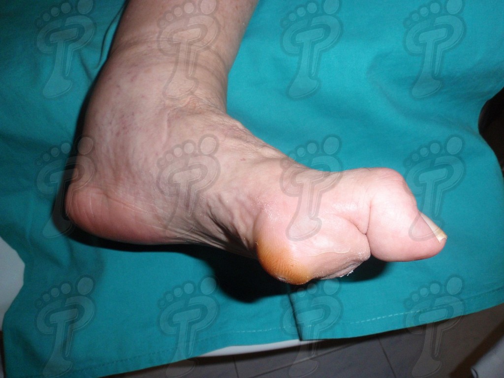 Hallux flexus: causes, clinical history and treatment
