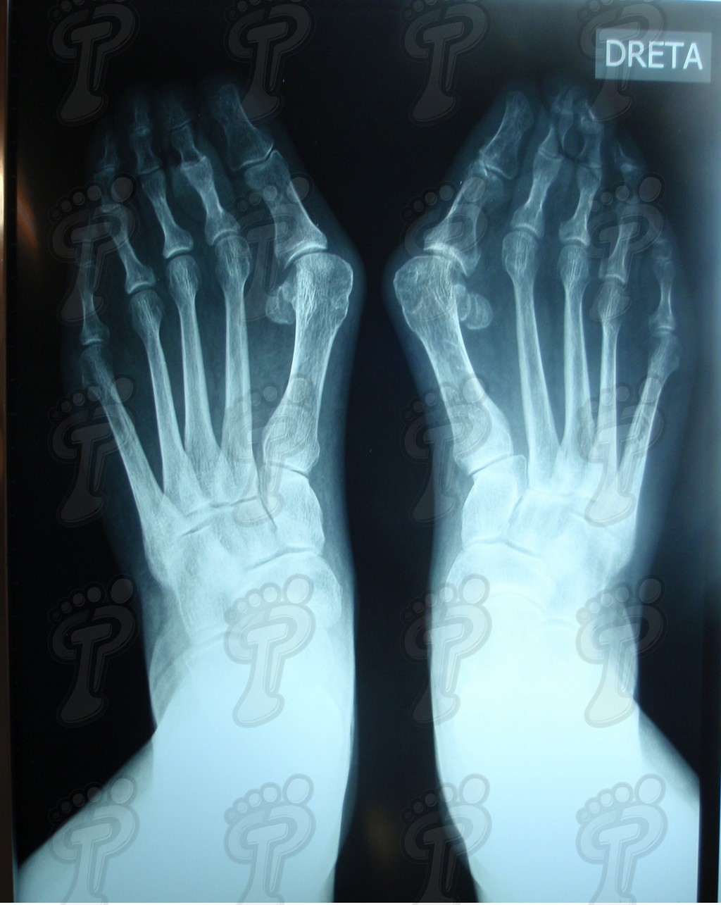 Hallux valgus: the most frequent structural alteration of the first radius