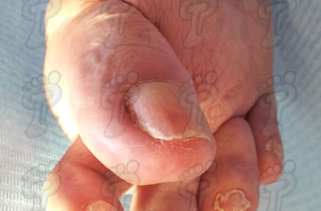 Hallux valgus: la alteración estructural más frecuente del primer radio