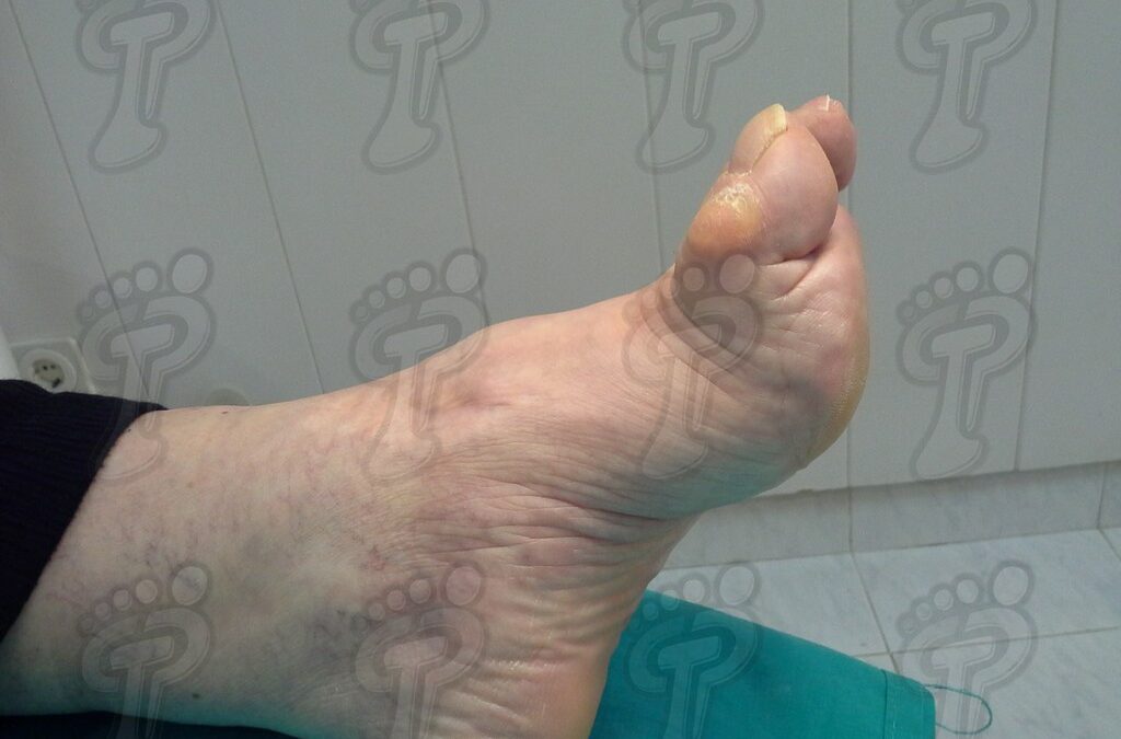 Hallux flexus: causas, clínica y tratamiento