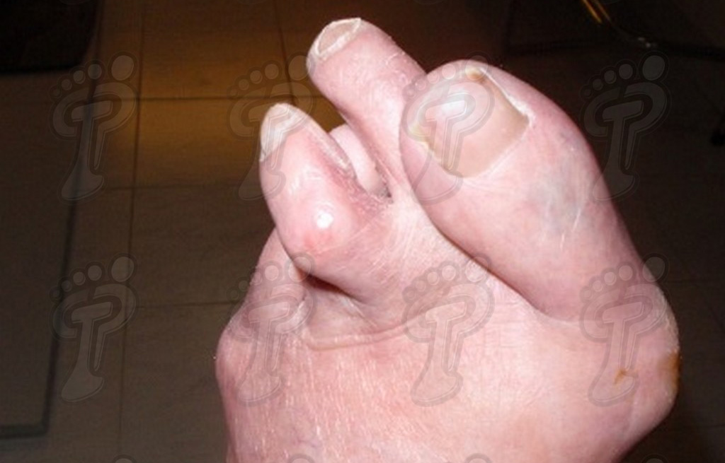 Врожденные пороки развития пальцев