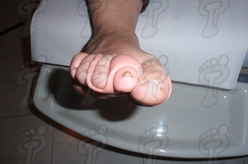 Aplicació de l’ortesi de silicona al peu