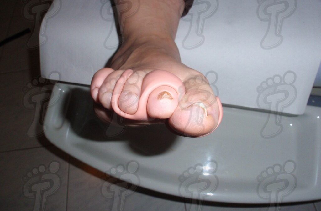 Aplicación de la ortesis de silicona en el pie