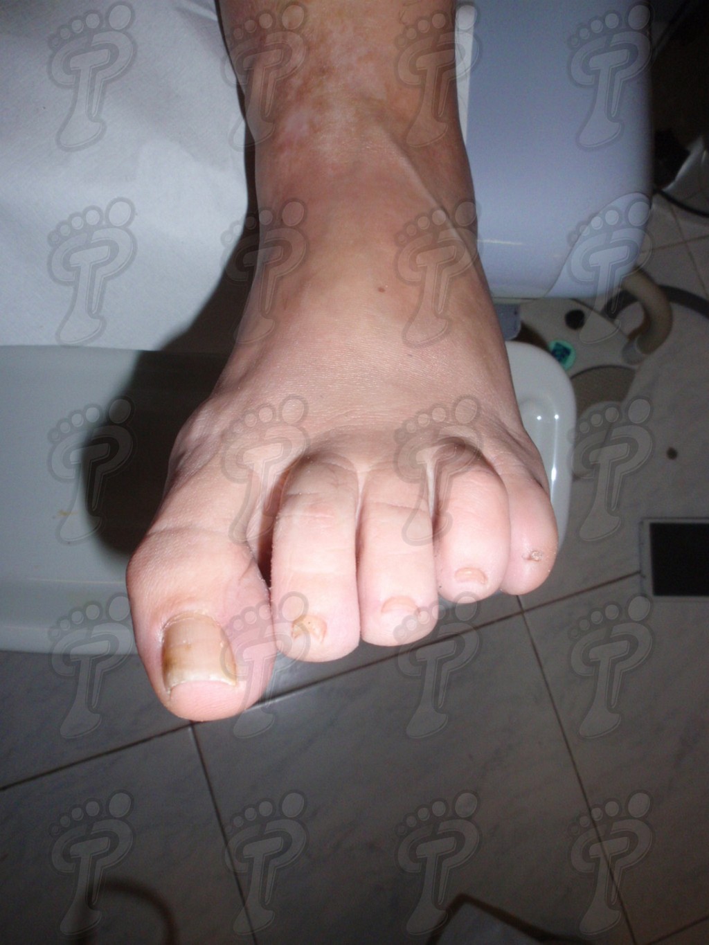 APPLICATION OF SILICONE ORTHESIS IN FOOT
