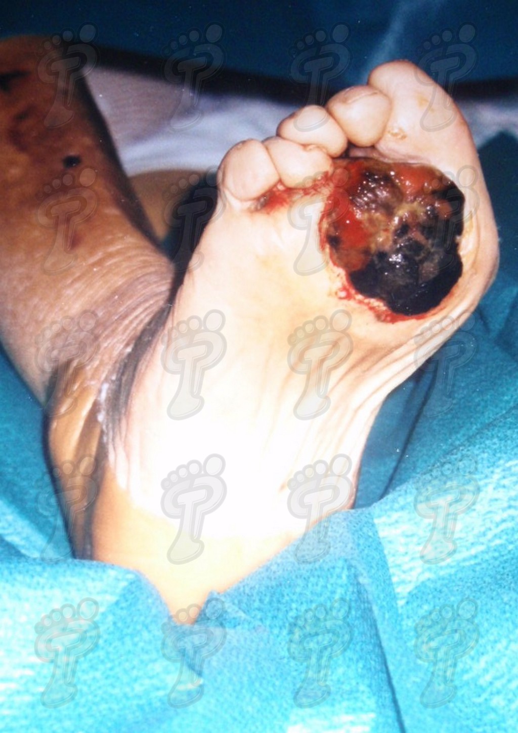 Malignant tumors in foot