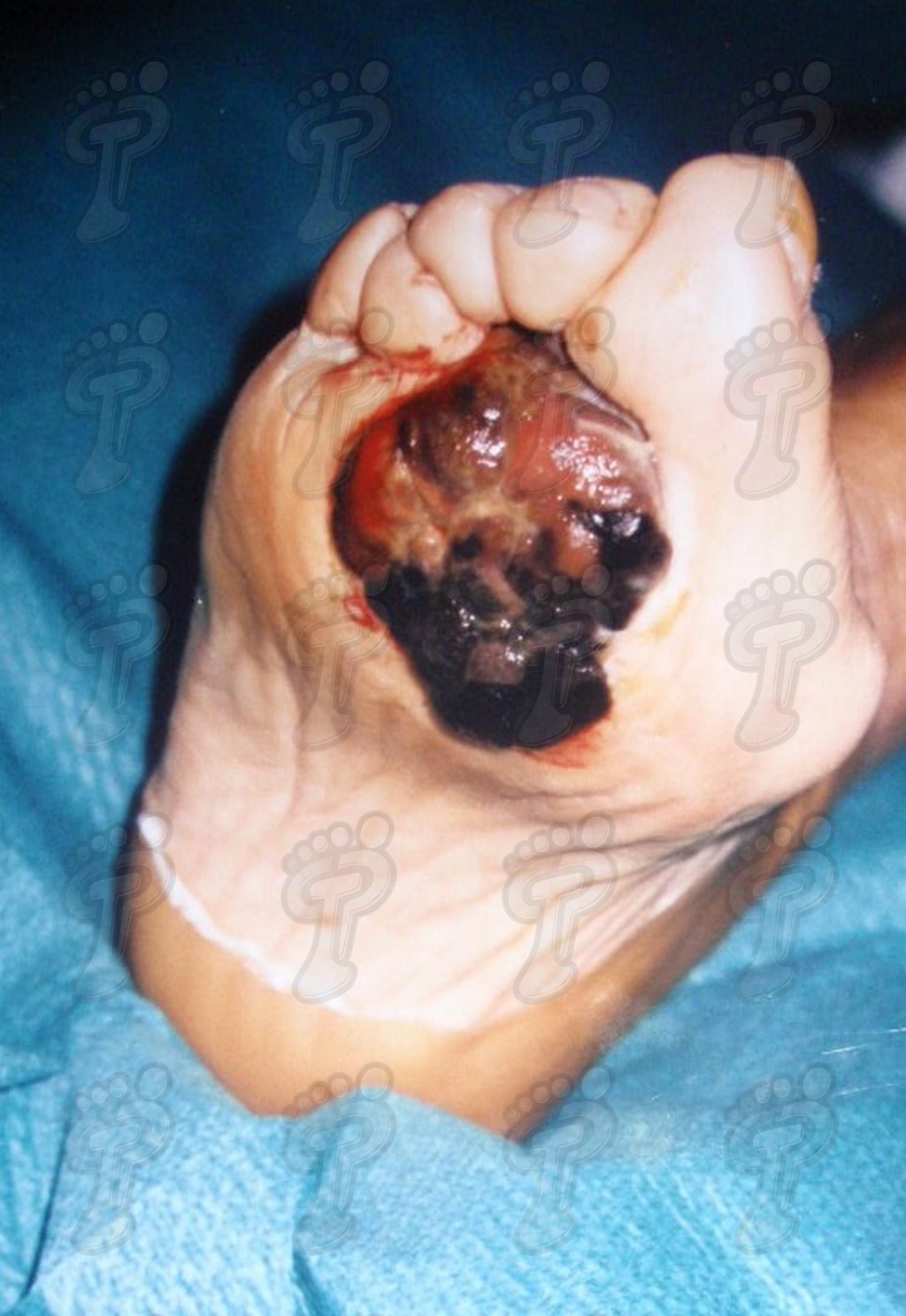 Злокачественные опухоли на ноге