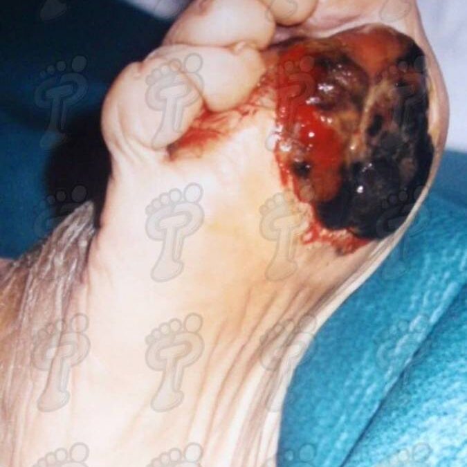 Malignant tumors in foot