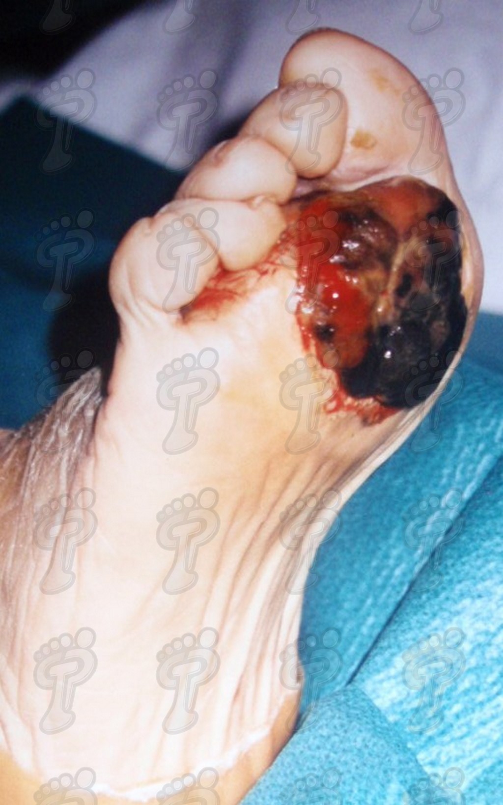 Malignant tumors in foot