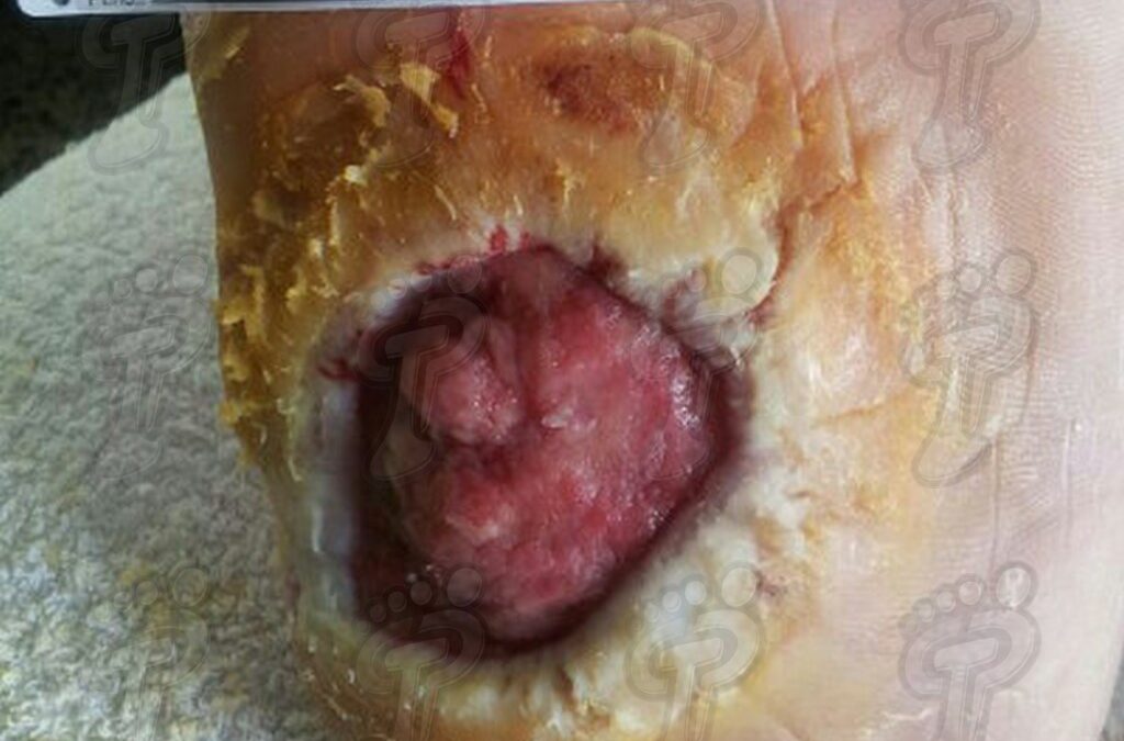 Consideraciones sobre el pie diabético