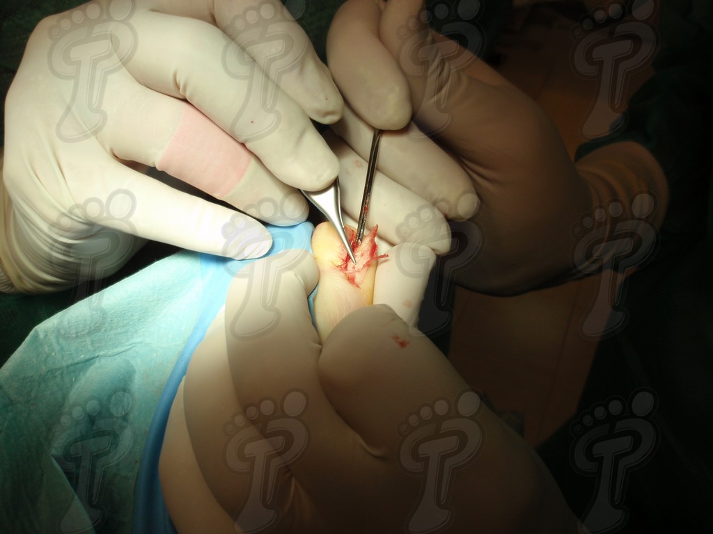 Cirurgia unguial mínimament invasiva
