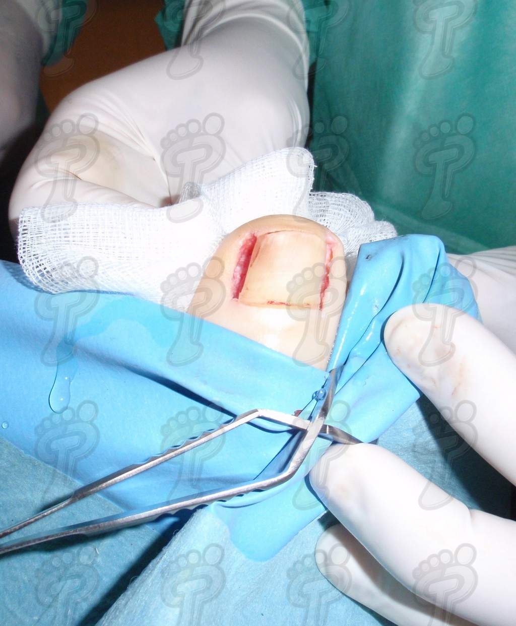 Unguinal surgery minimally invasive