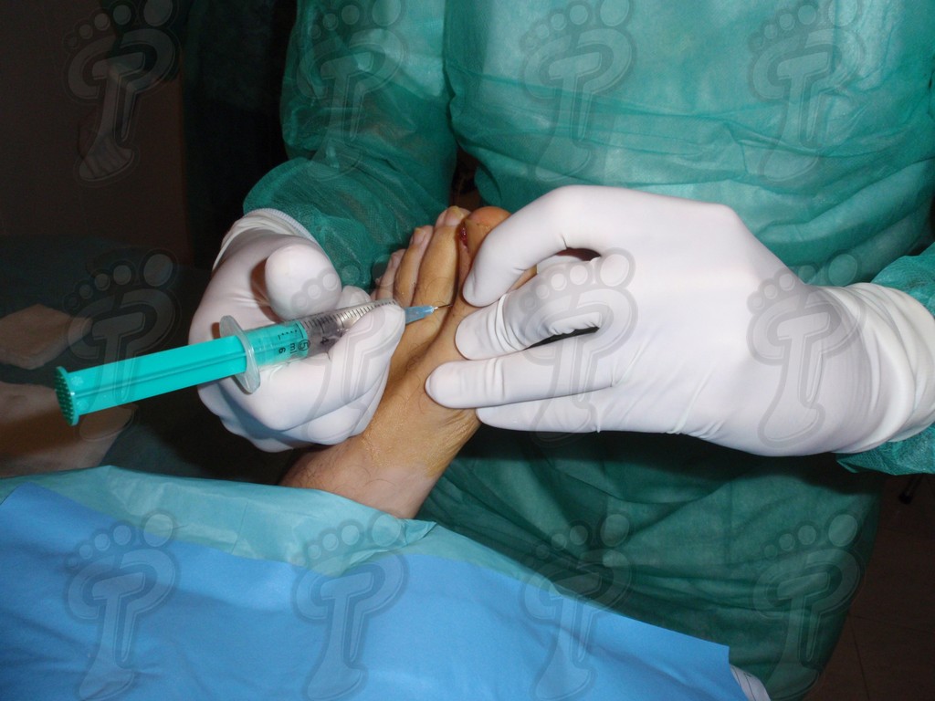 Cirugía ungueal mínimamente invasiva