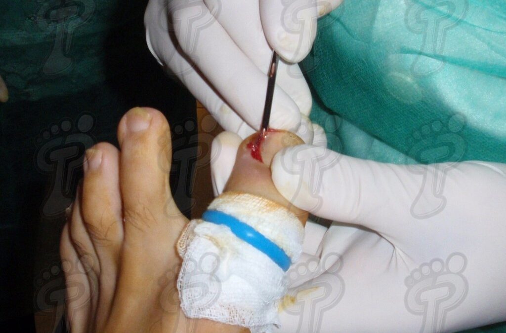 Cirugía ungueal mínimamente invasiva