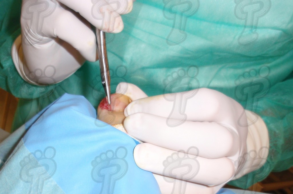 Unguinal surgery minimally invasive