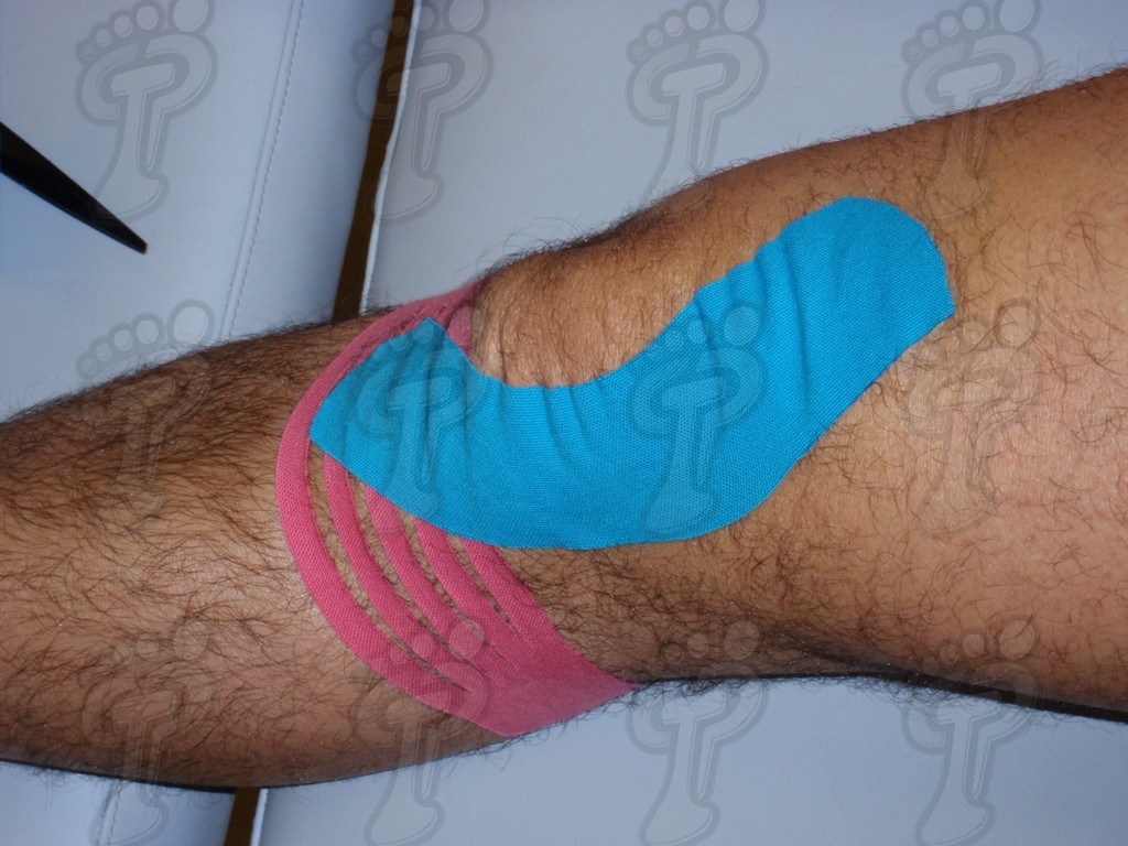 Application of neuromuscular bandages in the lower extremity