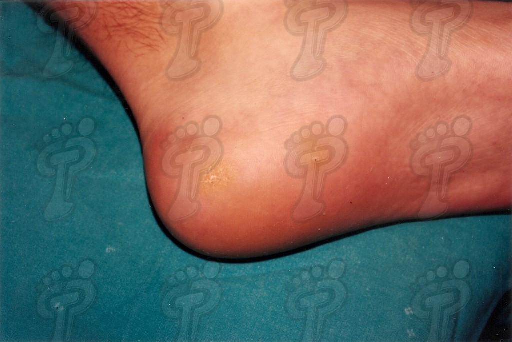 SURGICAL INTERVENTION OF PLANTAR WARTS