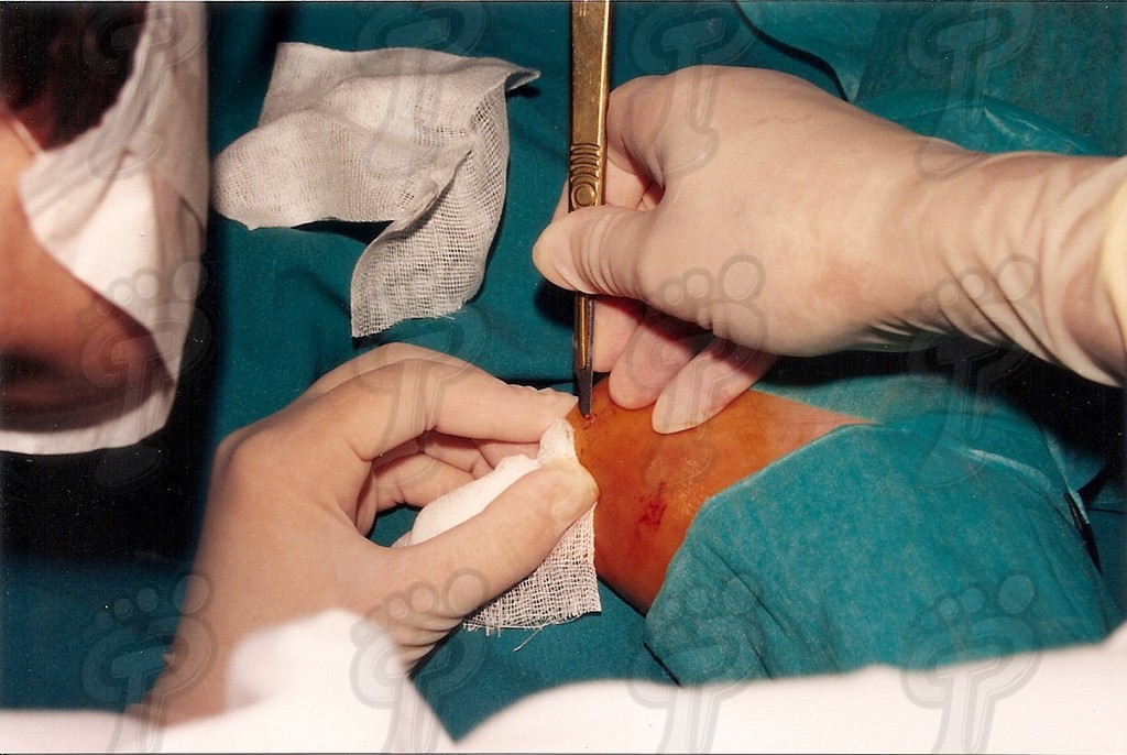 SURGICAL INTERVENTION OF PLANTAR WARTS