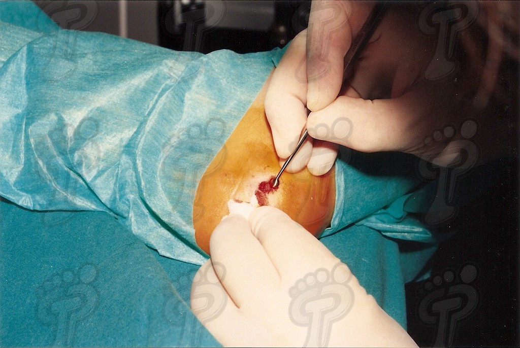 Intervención quirúrgica de verrugas plantares