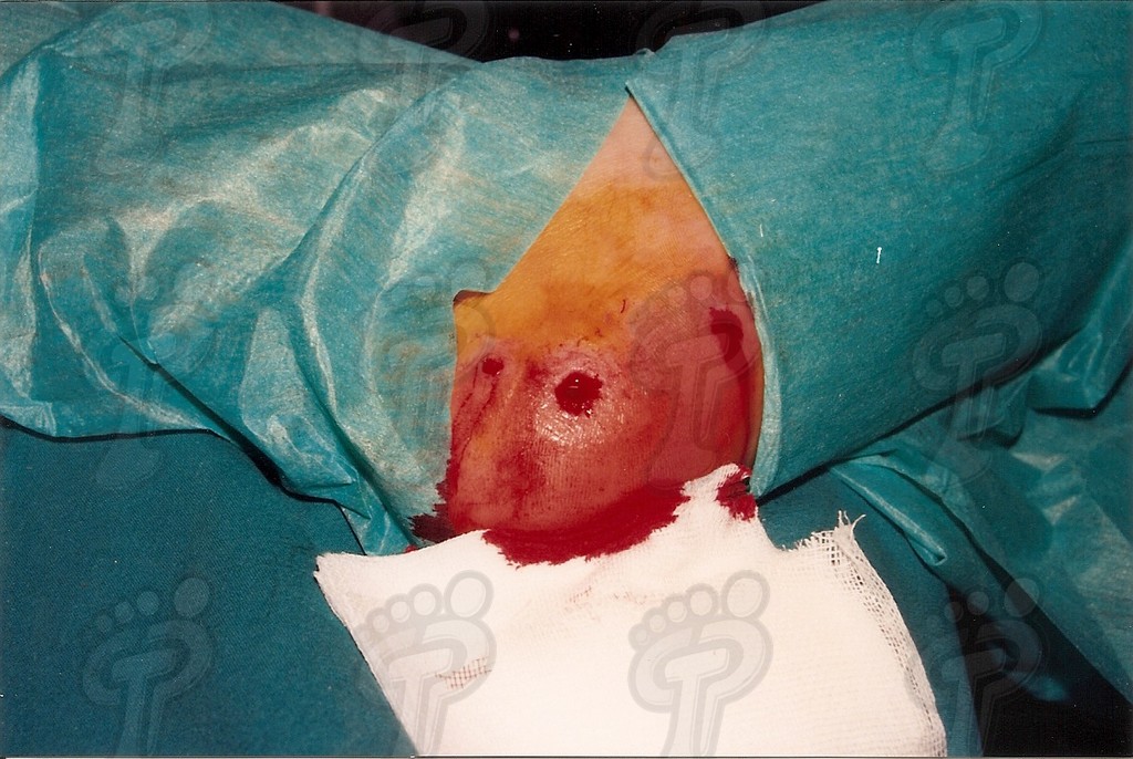 Intervenció quirúrgica de berrugues plantars