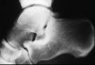 Biomecánica: articulación del tobillo