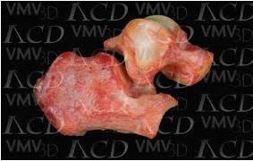 L’articulació subastragalina