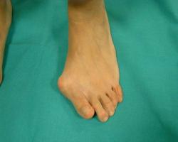 BUNIONS AND PLANTAR SUPPORTS